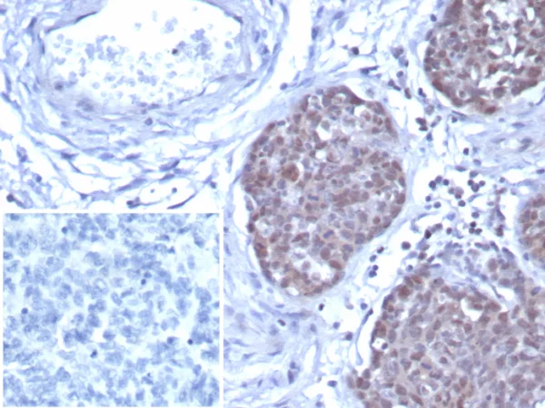 Formalin-fixed, paraffin-embedded human ovarian cancer stained with GATA-3 Recombinant Rabbit Monoclonal Antibody (GATA3/7686R). Inset: PBS instead of primary antibody; secondary only negative control.