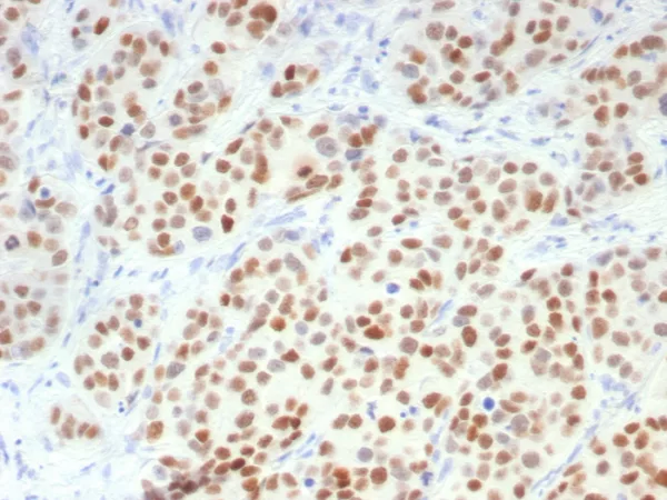 Formalin-fixed, paraffin-embedded human breast carcinoma stained with GATA-3 Recombinant Rabbit Monoclonal Antibody (GATA3/7686R). HIER: Tris/EDTA, pH9.0, 45min. 2°C: HRP-polymer, 30min. DAB, 5min.
