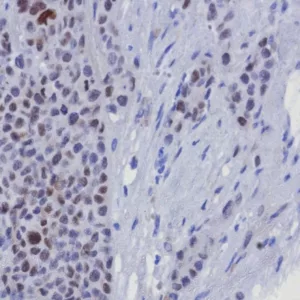 Formalin-fixed, paraffin-embedded human breast carcinoma stained with GATA-3 Recombinant Rabbit Monoclonal Antibody (GATA3/8327R). HIER: Tris/EDTA, pH9.0, 45min. 2°C: HRP-polymer, 30min. DAB, 5min.
