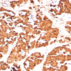 Formalin-fixed, paraffin-embedded human pituitary stained with Growth Hormone Recombinant Rabbit Monoclonal Antibody (GH/8136R). HIER: Tris/EDTA, pH9.0, 45min. 2: HRP-polymer, 30min. DAB, 5min.