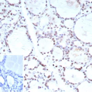 Formalin-fixed, paraffin-embedded human prostate carcinoma stained with FOXP1 Recombinant Rabbit Monoclonal Antibody (FOXP1/9381R). Inset: PBS instead of primary antibody; secondary only negative control.