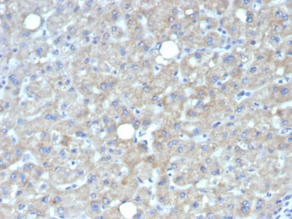 Formalin-fixed, paraffin-embedded human hepatocellular carcinoma stained with Glypican-3 Mouse Monoclonal Antibody (GPC3/7419). HIER: Tris/EDTA, pH9.0, 45min. 2°C: HRP-polymer, 30min. DAB, 5min.
