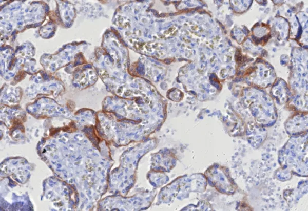 Formalin-fixed, paraffin-embedded human hepatocellular carcinoma stained with Glypican-3 Recombinant Rabbit Monoclonal Antibody (GPC3/8127R). HIER: Tris/EDTA, pH9.0, 45min. 2: HRP-polymer, 30min. DAB, 5min.