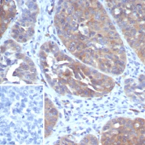 Formalin-fixed, paraffin-embedded human ovarian cancer stained with GCLM Mouse Monoclonal Antibody (GCLM/4069). Inset: PBS instead of primary antibody; secondary only negative control.