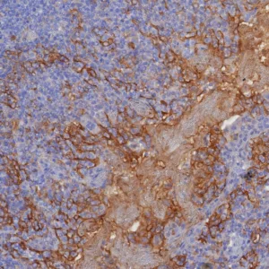 Formalin-fixed, paraffin-embedded human tonsil stained with PD-L1 Recombinant Rabbit Monoclonal Antibody (PDL1/8222R). HIER: Tris/EDTA, pH9.0, 45min. 2: HRP-polymer, 30min. DAB, 5min.