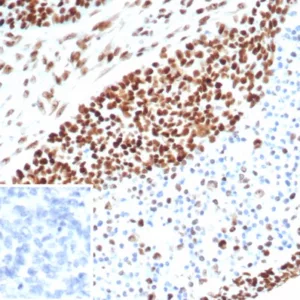 Formalin-fixed, paraffin-embedded human ovarian carcinoma stained with MSH6 Recombinant Rabbit Monoclonal Antibody (MSH6/7064R). Inset: PBS instead of primary antibody; secondary only negative control.