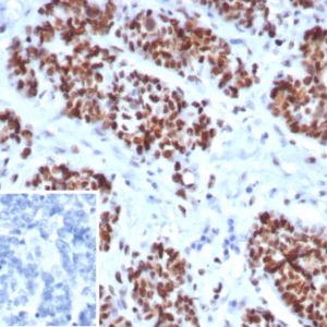 Formalin-fixed, paraffin-embedded human ovarian cancer stained with MSH6 Recombinant Rabbit Monoclonal Antibody (MSH6/8338R). Inset: PBS instead of primary antibody; secondary only negative control.