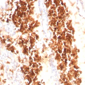 Formalin-fixed, paraffin-embedded human angiosarcoma stained with Glycophorin A Mouse Recombinant Monoclonal Antibody (rGYPA/8948). HIER: Tris/EDTA, pH9.0, 45min. 2°C: HRP-polymer, 30min. DAB, 5min.