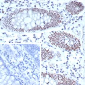 IHC analysis of formalin-fixed, paraffin-embedded human colon carcinoma. T-bet / TBX21 Mouse Monoclonal Antibody (TBX21/6724). Inset: PBS instead of primary antibody; secondary only negative control.
