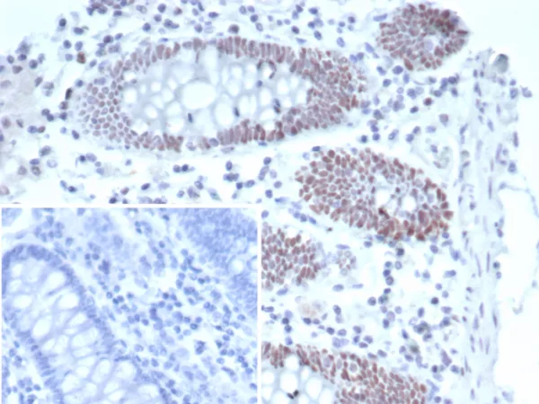 IHC analysis of formalin-fixed, paraffin-embedded human colon carcinoma. T-bet / TBX21 Mouse Monoclonal Antibody (TBX21/6724). Inset: PBS instead of primary antibody; secondary only negative control.