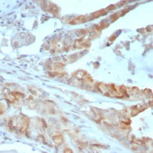 Formalin-fixed, paraffin-embedded human colon cancer stained with Annexin A2 Mouse Monoclonal Antibody (3D5/4). HIER: Tris/EDTA, pH9.0, 45min. 2°C: HRP-polymer, 30min. DAB, 5min.