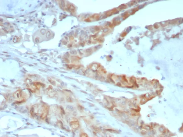 Formalin-fixed, paraffin-embedded human colon cancer stained with Annexin A2 Mouse Monoclonal Antibody (3D5/4). HIER: Tris/EDTA, pH9.0, 45min. 2°C: HRP-polymer, 30min. DAB, 5min.