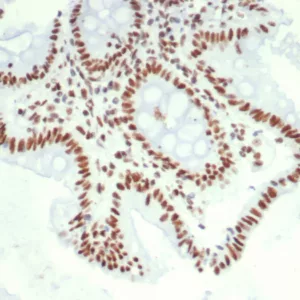 Formalin-fixed, paraffin-embedded human colon carcinoma stained with HDGF Mouse Monoclonal Antibody (PCRP-HDGF-1D1). HIER: Tris/EDTA, pH9.0, 45min. 2°C: HRP-polymer, 30min. DAB, 5min.