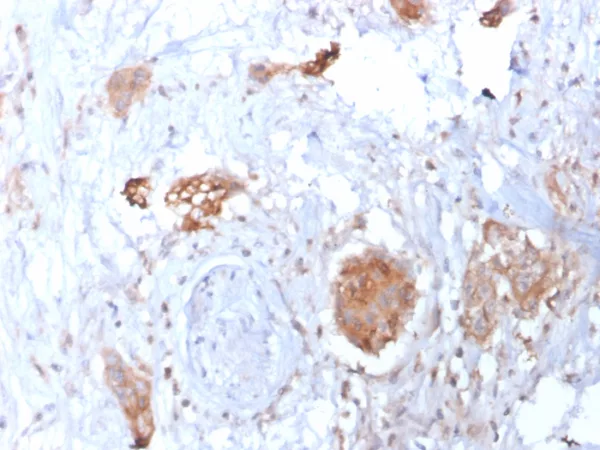 Formalin-fixed, paraffin-embedded human breast carcinoma stained with HIF1 alpha Mouse Monoclonal Antibody (HIF1A/3248). Inset: PBS instead of primary antibody; secondary only negative control.