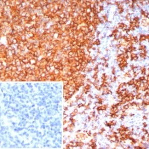Formalin-fixed, paraffin-embedded human tonsil stained with HLA-DR Monoclonal Antibody (HLA-DRB/7795R). Inset: PBS instead of primary antibody; secondary only negative control.