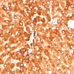 Formalin-fixed, paraffin-embedded human hepatocellular carcinoma stained with Haptoglobin Mouse Monoclonal Antibody (HP/4813). HIER: Tris/EDTA, pH9.0, 45min. 2°C: HRP-polymer, 30min. DAB, 5min.