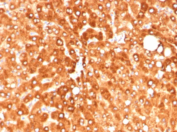 Formalin-fixed, paraffin-embedded human hepatocellular carcinoma stained with Haptoglobin Mouse Monoclonal Antibody (HP/4813). HIER: Tris/EDTA, pH9.0, 45min. 2°C: HRP-polymer, 30min. DAB, 5min.