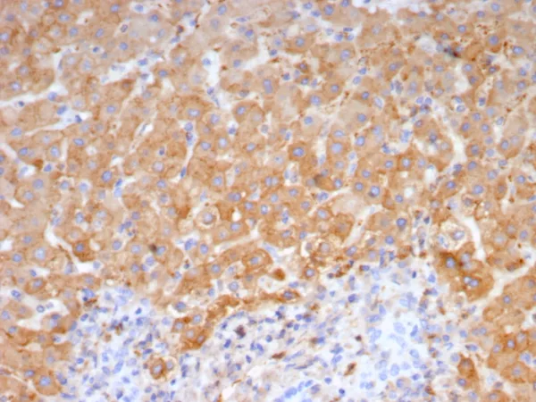 Formalin-fixed, paraffin-embedded human hepatocellular carcinoma stained with Haptoglobin Mouse Monoclonal Antibody (HP/4815). HIER: Tris/EDTA, pH9.0, 45min. 2°C: HRP-polymer, 30min. DAB, 5min.