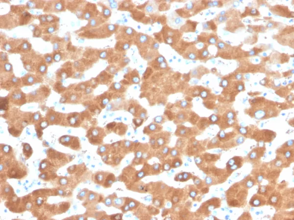 Formalin-fixed, paraffin-embedded human liver carcinoma in colon stained with Haptoglobin Mouse Monoclonal Antibody (HP/3832). HIER: Tris/EDTA, pH9.0, 45min. 2°C: HRP-polymer, 30min. DAB, 5min.
