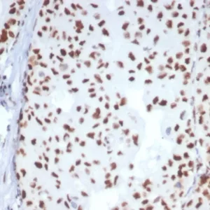 Formalin-fixed, paraffin-embedded human breast carcinoma stained with HSPA1B Mouse Monoclonal Antibody (HSPA1B/7624). HIER: Tris/EDTA, pH9.0, 45min. 2°C: HRP-polymer, 30min. DAB, 5min.