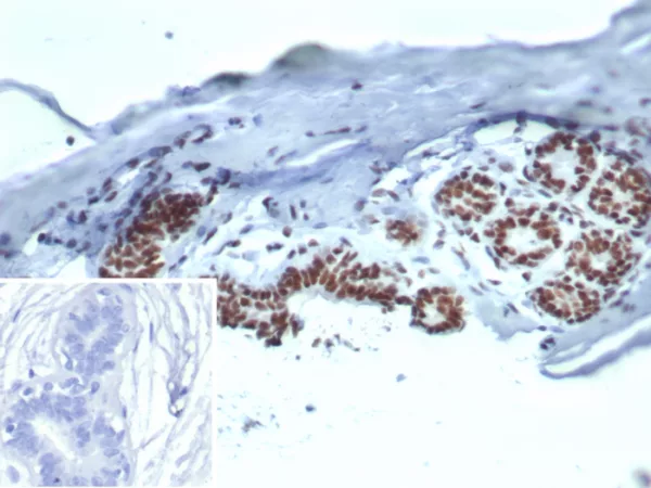 Formalin-fixed, paraffin-embedded human breast carcinoma stained with HSPA1B Mouse Monoclonal Antibody (HSPA1B/7626). Inset: PBS instead of primary antibody; secondary only negative control.