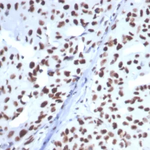 Formalin-fixed, paraffin-embedded human breast carcinoma stained with HSPA1B Mouse Monoclonal Antibody (HSPA1B/7628). HIER: Tris/EDTA, pH9.0, 45min. 2°C: HRP-polymer, 30min. DAB, 5min.