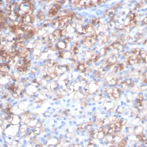 Formalin-fixed, paraffin-embedded human renal cell carcinoma stained with HSP27 Recombinant Mouse Monoclonal Antibody (rHSPB1/7298). HIER: Tris/EDTA, pH9.0, 45min. 2°C: HRP-polymer, 30min. DAB, 5min.