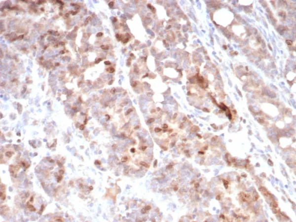 Formalin-fixed, paraffin-embedded human colon carcinoma stained with Survivin / BIRC5 Mouse Monoclonal Antibody (BIRC5/7775). HIER: Tris/EDTA, pH9.0, 45min. 2°C: HRP-polymer, 30min. DAB, 5min.