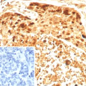 Formalin-fixed, paraffin-embedded human ovarian cancer stained with Survivin Recombinant Rabbit Monoclonal Antibody (BIRC5/8936R). Inset: PBS instead of primary antibody; secondary only negative control.
