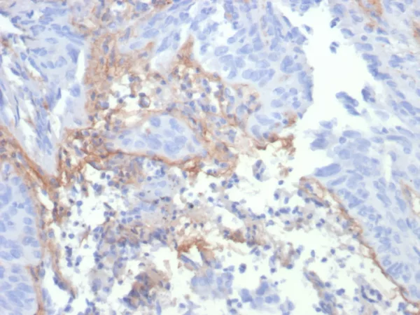 Formalin-fixed, paraffin-embedded human lung stained with Tenascin C Mouse Recombinant Monoclonal Antibody (TNC/4806). HIER: Tris/EDTA, pH9.0, 45min. 2°C: HRP-polymer, 30min. DAB, 5min.
