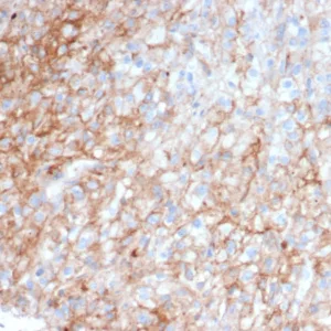 Formalin-fixed, paraffin-embedded human kidney carcinoma stained with CD54 / ICAM-1 Mouse Monoclonal Antibody (ICAM1/6968). HIER: Tris/EDTA, pH9.0, 45min. 2°C: HRP-polymer, 30min. DAB, 5min.