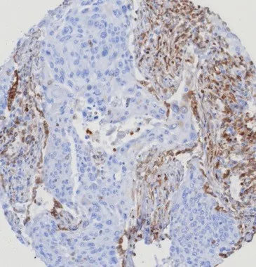 Formalin-fixed, paraffin-embedded human lung cancer stained with STING1 Mouse Monoclonal Antibody (STING1/7439). HIER: Tris/EDTA, pH9.0, 45min. 2°: HRP-polymer, 30min. DAB, 5min. STING1 Antibody in Immunohistochemistry (IHC (P))
