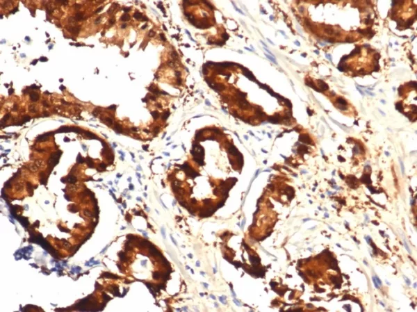 FFPE human prostate with IDH1-R132H mutation stained with IDH1-R132H Recombinant Rabbit MAb (IDH1.R132H/7328R). HIER: Tris/EDTA, pH9.0, 45min. 2°C: HRP-polymer, 30min. DAB, 5min.