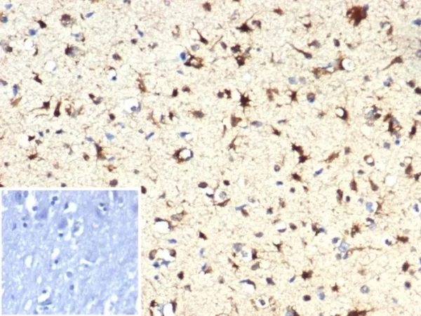 FFPE human brain with IDH1-R132H mutation stained with IDH1-R132H Recombinant Rabbit MAb (IDH1.R132H/7328R). Inset: PBS instead of primary antibody; secondary only negative control.