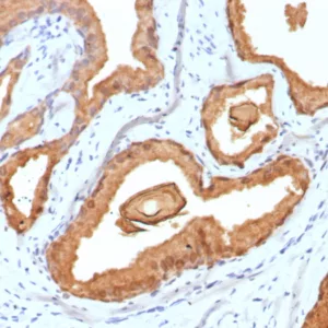 Formalin-fixed, paraffin-embedded human prostate carcinoma stained with PSA Recombinant Mouse Monoclonal Antibody (rKLK3/6947). HIER: Tris/EDTA, pH9.0, 45min. 2: HRP-polymer, 30min. DAB, 5min.