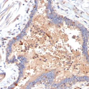 Formalin-fixed, paraffin-embedded human COVID positive lung stained with IL-6 Mouse Monoclonal Antibody (IL6/4642) at 2ug/ml. HIER: Tris/EDTA, pH9.0, 45min. 2°C: HRP-polymer, 30min. DAB, 5min.