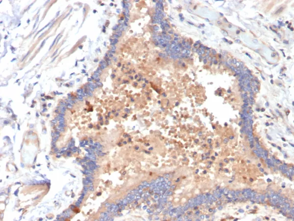 Formalin-fixed, paraffin-embedded human COVID positive lung stained with IL-6 Mouse Monoclonal Antibody (IL6/4642) at 2ug/ml. HIER: Tris/EDTA, pH9.0, 45min. 2°C: HRP-polymer, 30min. DAB, 5min.