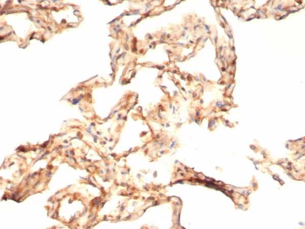Formalin-fixed, paraffin-embedded human COVID positive lung stained with IL-6 Mouse Monoclonal Antibody (IL6/4643) at 2ug/ml. HIER: Tris/EDTA, pH9.0, 45min. 2°C: HRP-polymer, 30min. DAB, 5min.
