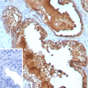Formalin-fixed, paraffin-embedded human prostate cancer stained with IL10 Mouse Monoclonal Antibody (IL10/8711). Inset: PBS instead of primary antibody; secondary only negative control.