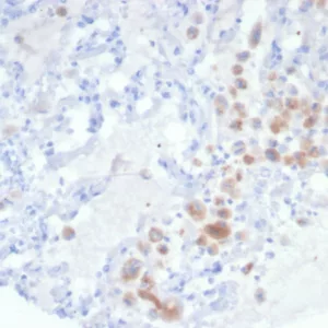 Formalin-fixed, paraffin-embedded human lung stained with IRS1 Mouse Monoclonal Antibody (IRS1/7571). HIER: Tris/EDTA, pH9.0, 45min. 2°C: HRP-polymer, 30min. DAB, 5min.