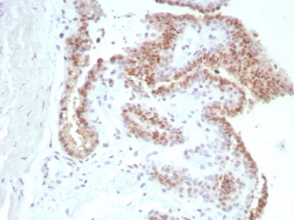Formalin-fixed, paraffin-embedded human prostate carcinoma stained with Androgen Receptor Recombinant Mouse Monoclonal Antibody (rDHTR/8818).  HIER: Tris/EDTA, pH9.0, 45min. 2°C: HRP-polymer, 30min. DAB, 5min.