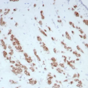 Formalin-fixed, paraffin-embedded human breast carcinoma stained with Androgen Receptor Recombinant Rabbit Monoclonal Antibody (DHTR/8698R). HIER: Tris/EDTA, pH9.0, 95C/45min. 2Ab: HRP-Poly:30min. DAB:5min.