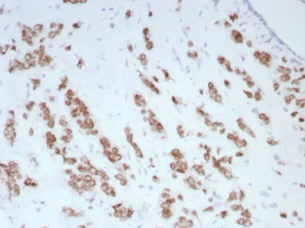 Formalin-fixed, paraffin-embedded human breast carcinoma stained with Androgen Receptor Recombinant Rabbit Monoclonal Antibody (DHTR/8698R). HIER: Tris/EDTA, pH9.0, 95C/45min. 2Ab: HRP-Poly:30min. DAB:5min.