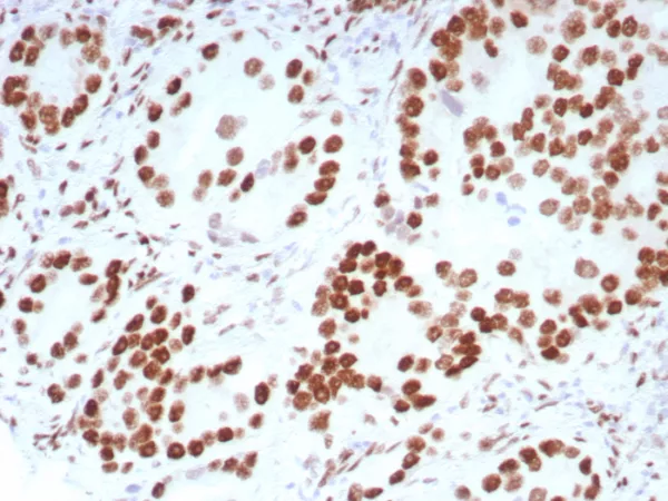 Formalin-fixed, paraffin-embedded human prostate carcinoma stained with Androgen Receptor Recombinant Rabbit Monoclonal Antibody (DHTR/8698R).  HIER: Tris/EDTA, pH9.0, 95C/45min. 2Ab: HRP-Poly:30min. DAB:5min.