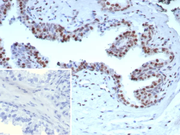 Formalin-fixed, paraffin-embedded human prostate carcinoma stained with Androgen Receptor Recombinant Rabbit Monoclonal Antibody (DHTR/9119R).  HIER: Tris/EDTA, pH9.0, 95°C/45min. 2°CAb: HRP-Poly:30min. DAB:5min.