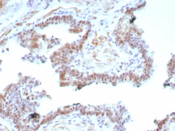 Formalin-fixed, paraffin-embedded human prostate carcinoma stained with AR Recombinant Rabbit Monoclonal Antibody (DHTR.V7/9125R).  HIER: Tris/EDTA, pH9.0, 95°C/45min. 2°CAb: HRP-Poly:30min. DAB:5min.