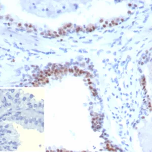 Formalin-fixed, paraffin-embedded human prostate carcinoma stained with AR Recombinant Rabbit Monoclonal Antibody (DHTR.V7/9394R).  HIER: Tris/EDTA, pH9.0, 95°C/45min. 2°CAb: HRP-Poly:30min. DAB:5min.