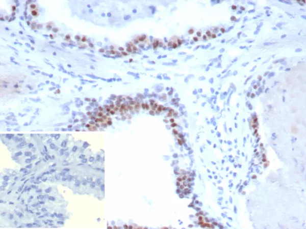Formalin-fixed, paraffin-embedded human prostate carcinoma stained with AR Recombinant Rabbit Monoclonal Antibody (DHTR.V7/9394R).  HIER: Tris/EDTA, pH9.0, 95°C/45min. 2°CAb: HRP-Poly:30min. DAB:5min.