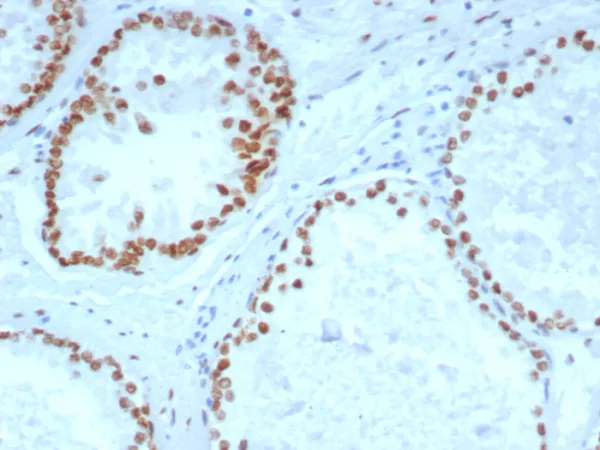 Formalin-fixed, paraffin-embedded human prostate carcinoma stained with Androgen Receptor Recombinant Rabbit Monoclonal Antibody (DHTR/4929R).  HIER: Tris/EDTA, pH9.0, 95°C/45min. 2°CAb: HRP-Poly:30min. DAB:5min.