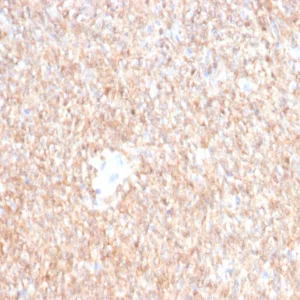 Formalin-fixed, paraffin-embedded human GIST stained with CD117 Mouse Monoclonal Antibody (C117/6347). HIER: Tris/EDTA, pH9.0, 45min. 2°C: HRP-polymer, 30min. DAB, 5min.